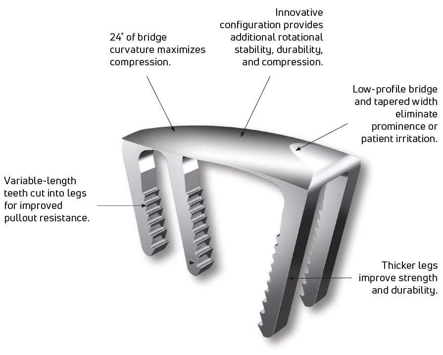 The DynaClip Delta™’s unique 4-leg, triangular configuration offers enhanced compression and rotational stability, rendering it the optimal selection for robust NiTiNOL staples in 1st MTP fusion procedures.
