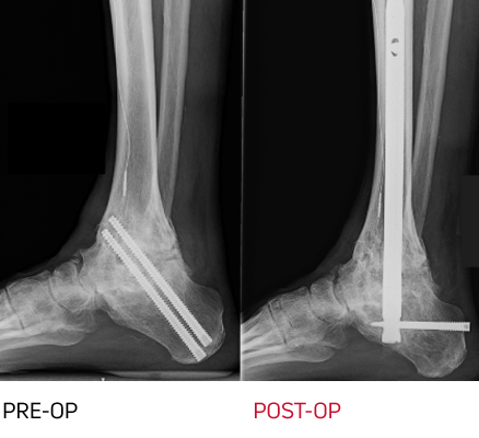 x-ray - arthrodesis non union
