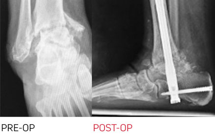x-ray - Diabetics-Smokers - Charcot Example.jpg