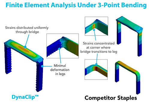 The staple design of the DynaClip® Bone Fixation System features a broad and low-profile bridge as well as thickened legs, setting it apart from our competitor’s designs.