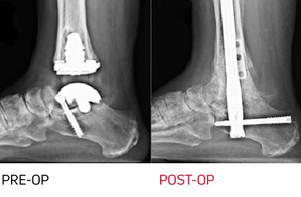 x-ray - failed total ankle