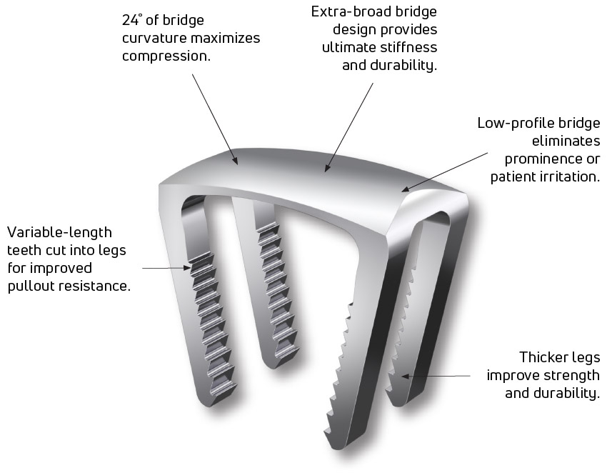 The DynaClip Quattro™’s unique 4-leg, triangular configuration offers enhanced compression and rotational stability, making it the viable choice for robust NiTiNOL staples in midfoot fusion procedures.
