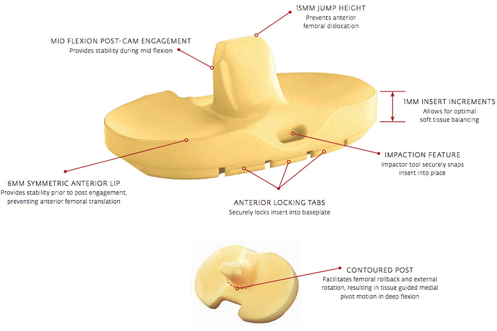 TIBIAL INSERT